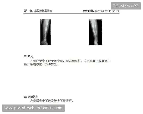 格拉迪胫腓骨骨折缺阵4个月，朗斯锋线受考验